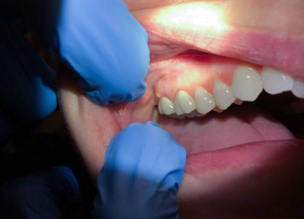 Best Emergency Root Canal Treatment in Candler Mcafee, GA